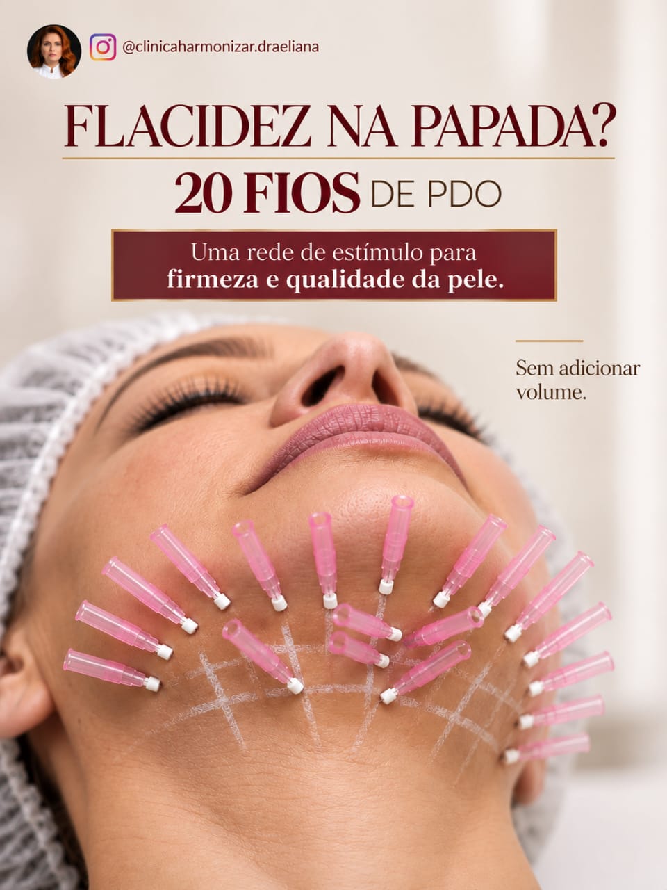 Flacidez na papada: 20 fios de PDO